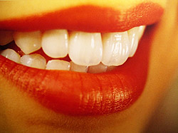 Новости стоматологии - керамические виниры